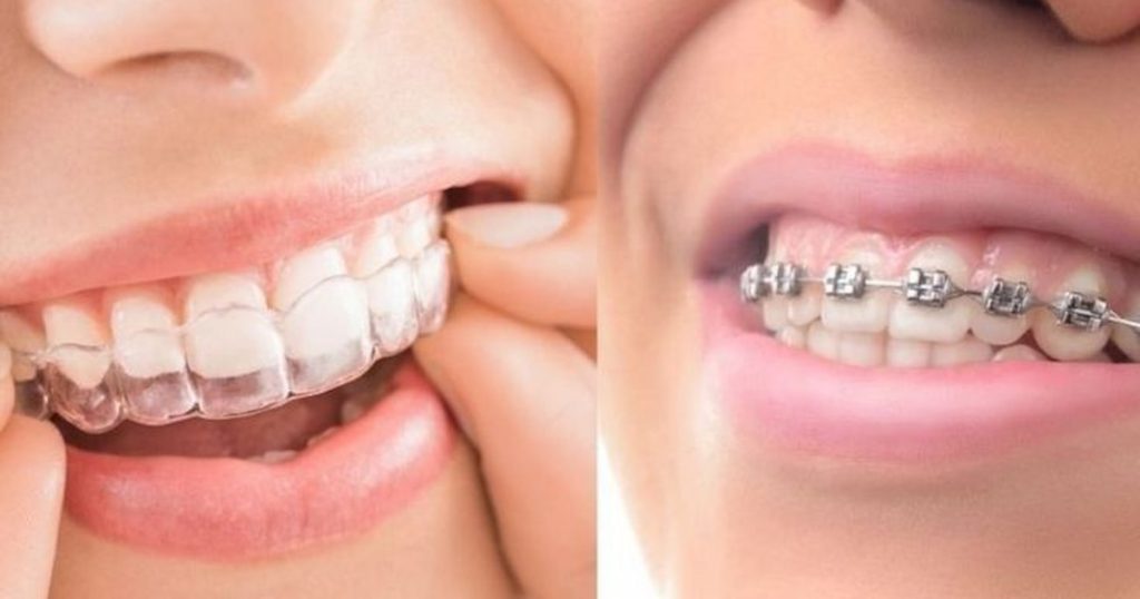 Invisalign vs. Traditional Braces
